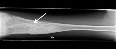 Severe chronic non-bacterial osteomyelitis in combination with total MPO deficiency and responsiveness to TNFα inhibition